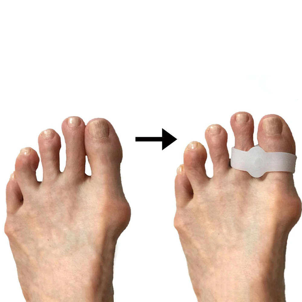 2 елемента Сепаратор за вальгусной деформация на палеца на крака с две дупки Силиконов Гел за защита на пръстите на краката Средство за педикюр палеца Инструмент за грижа за краката Изображение 5