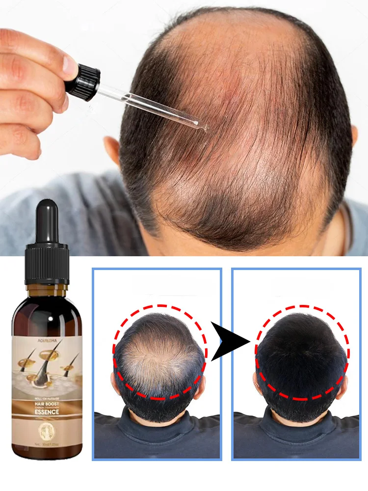 Масло за растежа на косата Унисекс За лечение на косопад, за Бърз растеж на косата Ефективно лечение на Наследствено оплешивяване Послеродовое косопад Изображение 0